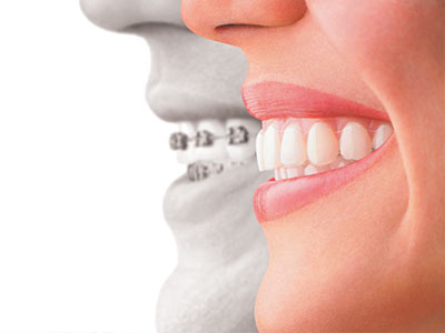 The image shows a split-screen comparison between a smiling person's face and an x-ray of a mouth with braces, highlighting the transformation from a natural smile to one with orthodontic treatment.