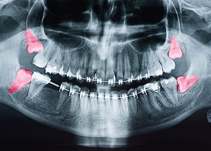 The image shows an X-ray of a human skull with red dots indicating areas of interest or concern, possibly for dental or medical purposes.