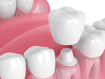 The image shows a close-up view of multiple teeth with a focus on their structure and surfaces, set against a pink background that resembles dental wax or a similar material used for impressions.