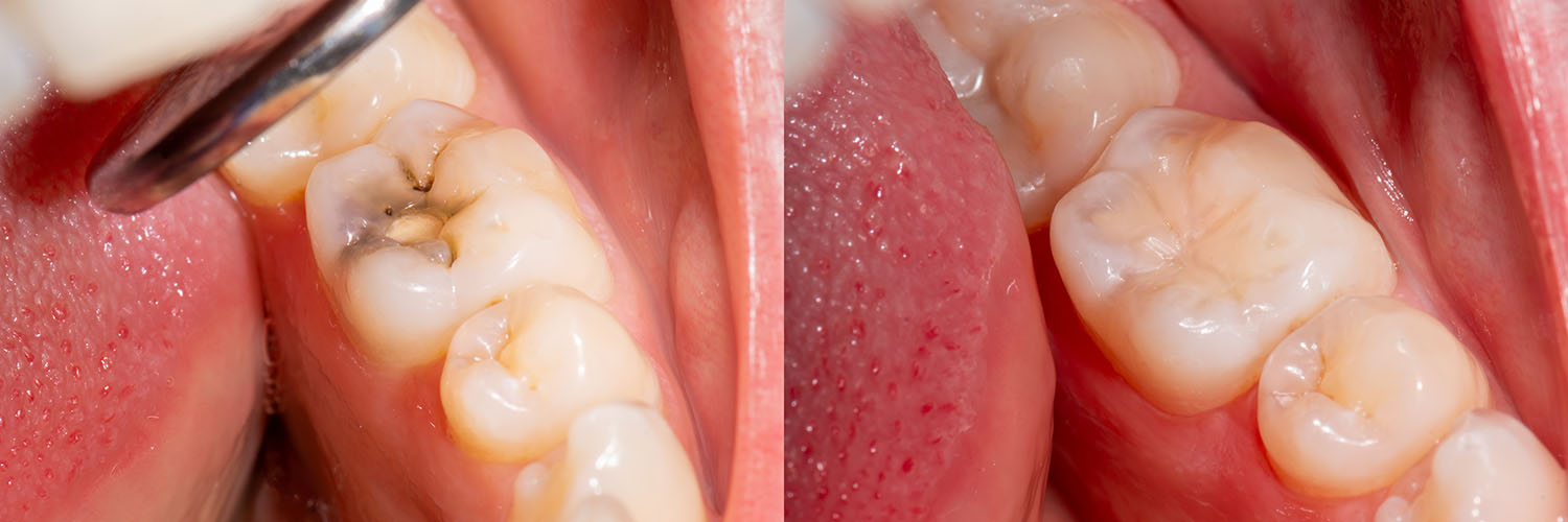 The image shows a close-up view of a dental implant with multiple teeth surrounding it, featuring a screw visible through the gum tissue.